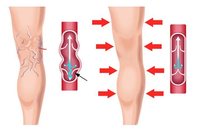 Effet du gel Levicose dans le traitement