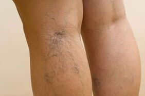 Comment manifester des varices chez les femmes
