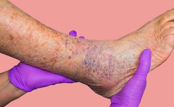 Pourquoi les varices sont-elles dangereuses