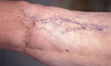 Méthodes de traitement des varices sur les jambes