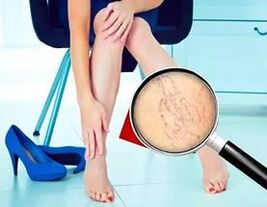 Les symptômes dépendent du type et du stade des varices