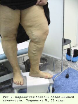 Les varices doivent être traitées pour arrêter le processus