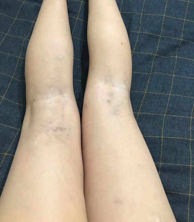 Manifestations de varices sur les jambes