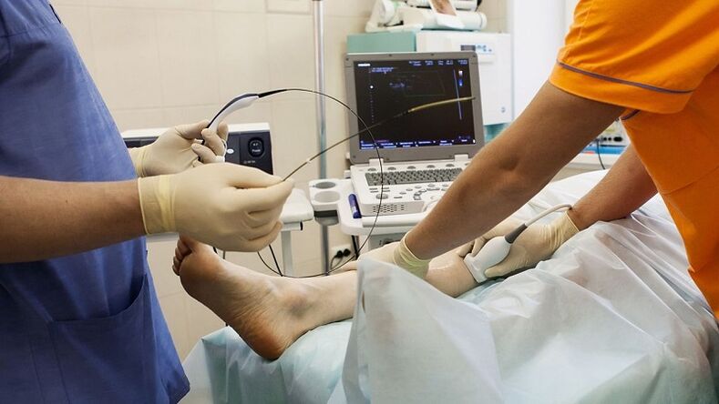 Chirurgie pour enlever les varices
