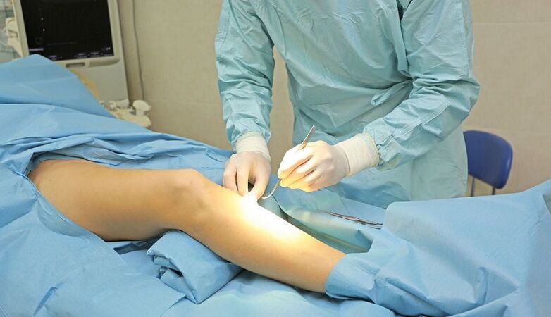 Phlébectomie pour varices