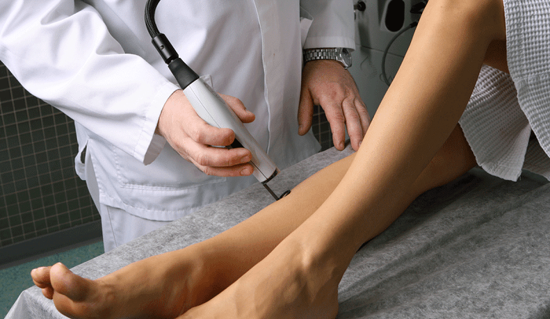 Traitement au laser des varices
