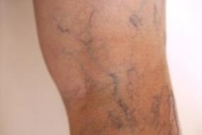 Varices sur les jambes