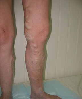veines saillantes sur la jambe en raison de varices