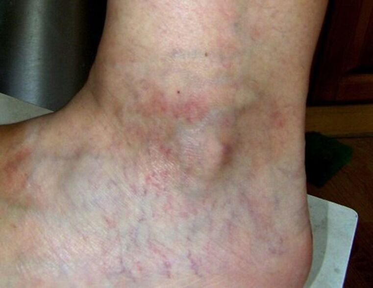 Varices sur la jambe