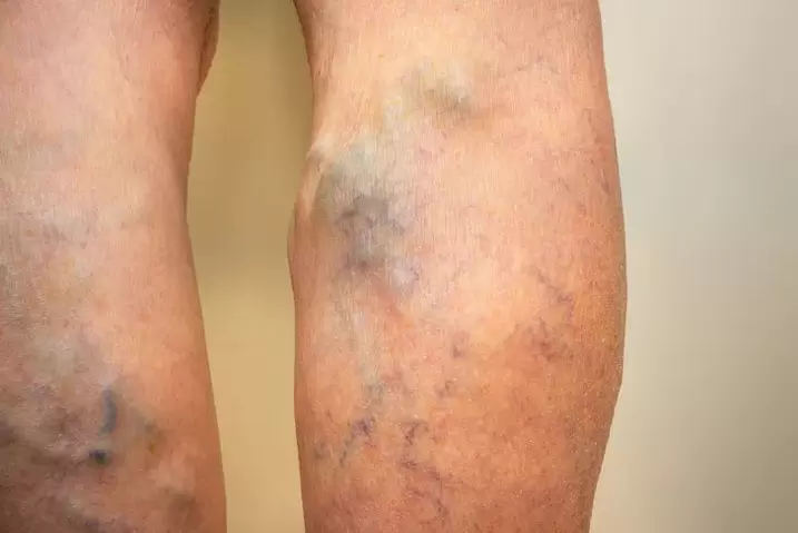 varices des jambes