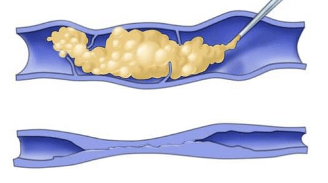 Sclérothérapie des varices